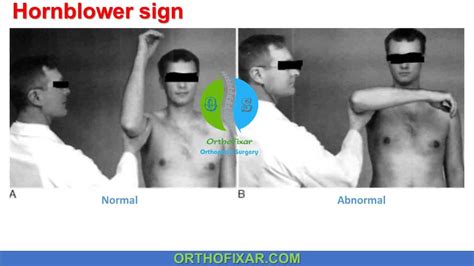 drop shoulder test|positive hornblower's sign.